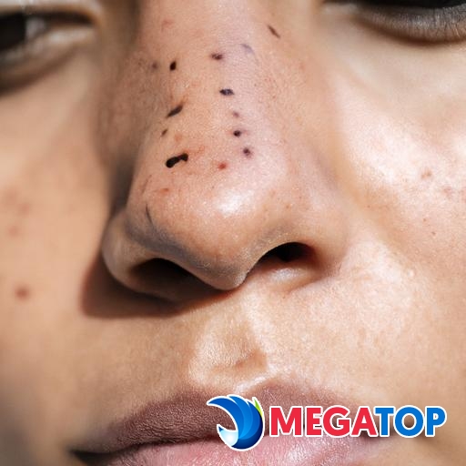 Một bức ảnh chụp cận cảnh khuôn mặt của một phụ nữ với những nốt ruồi đặc trưng trên mí mắt, mũi và môi.